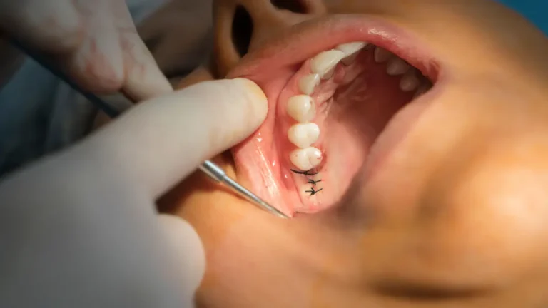 Perda de dentes e suas consequências